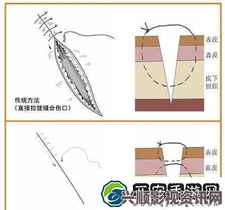 竹板打肿臂缝合不上，如何有效处理创伤与修复？